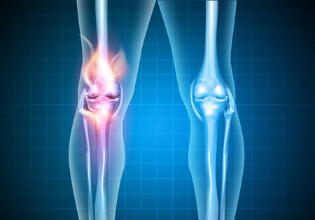Knee restoration Xray