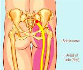 Sciatica in colour diagram