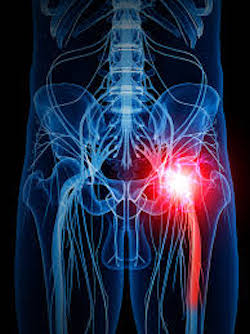 Sciatica nerve highlighted