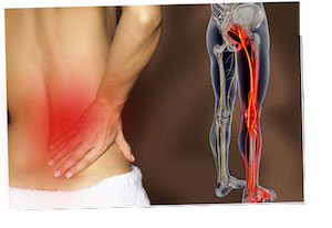 Sciatica pain in the back
