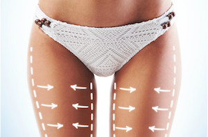 Celluliate free thighs