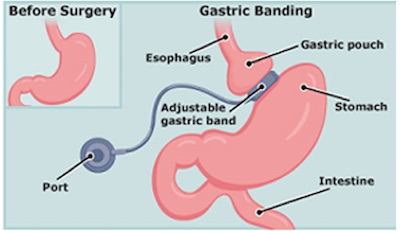 Gastric Band picture of stomach 